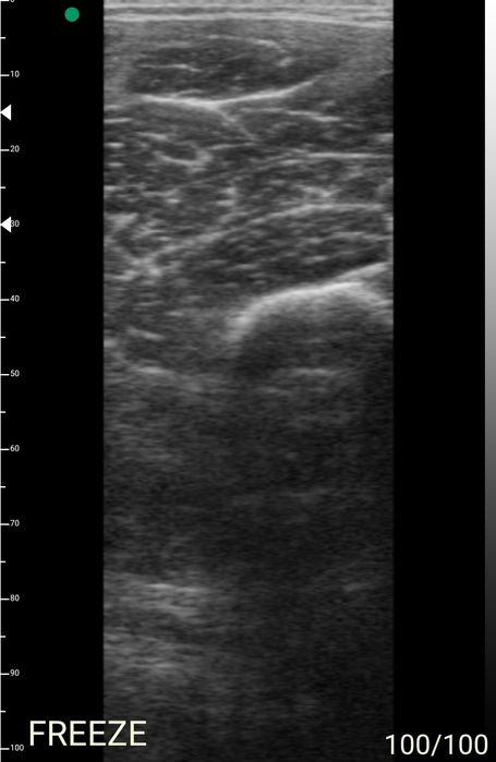 Ecografo portátil Sonostar Uprobe L5c