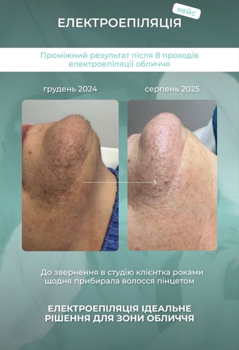 Електроепіляція,правий берег
