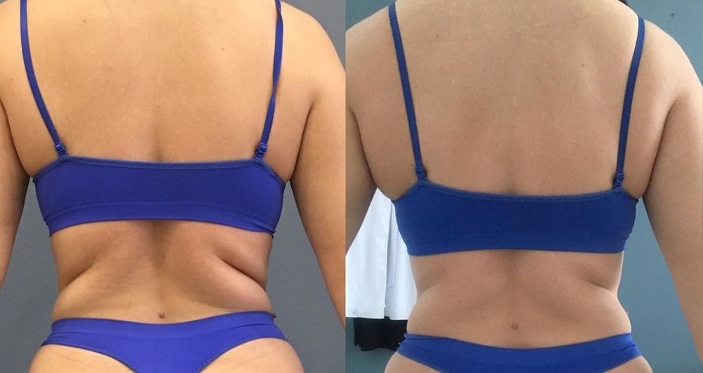 Массаж Антицеллюлитный, Классический, Лимфодренажный