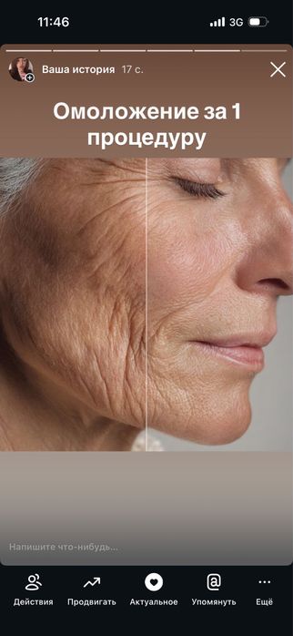 Косметолог моделі на(губи,ботокс,смас,рф голка,схуднення,худе обличчя)