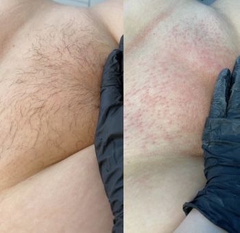 Депіляція віск Депиляция Воск Чернігів УЗ чистка обличчя