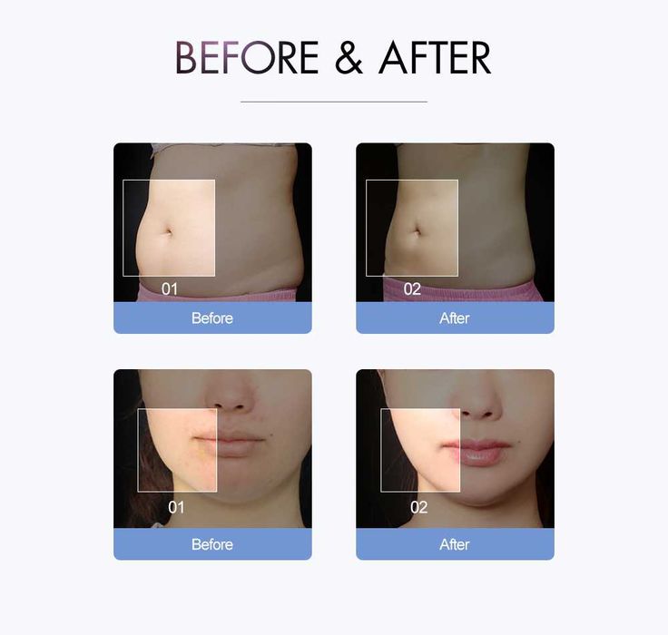 Maquina S Shaper Cavitação 50 watts + Radiofrequencia + Vácuo