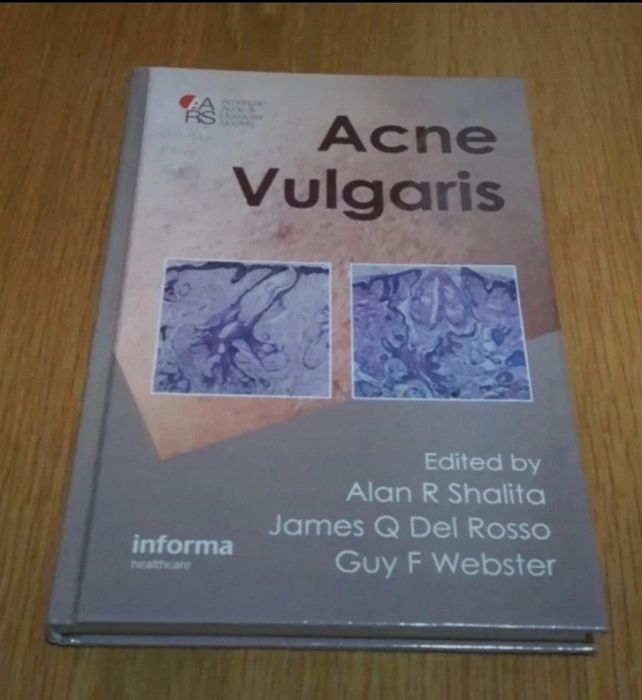 Livro Acne Vulgaris | book in english