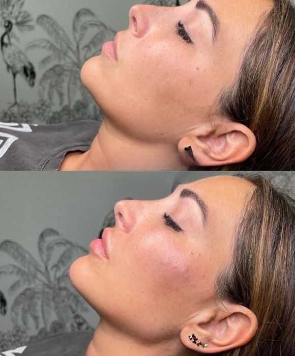 Збільшення губ ,Ботокс,Full Face,ліполітики