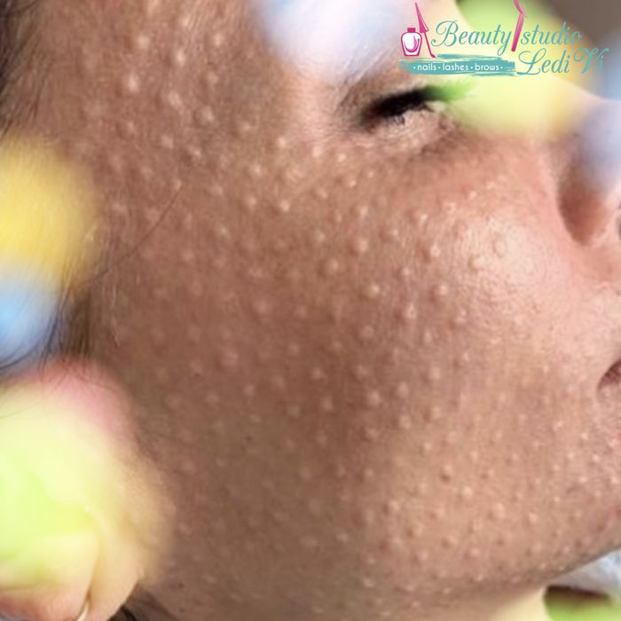 PROMOCJA! Botoks  320 Za 1 strefa