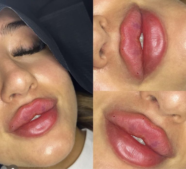 Powiekszanie ust PROMOCJA !!! Botox 200 zl