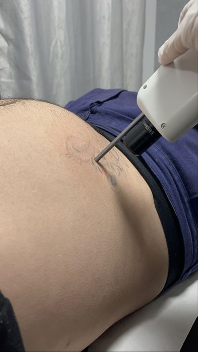 Remoção de tatuagem