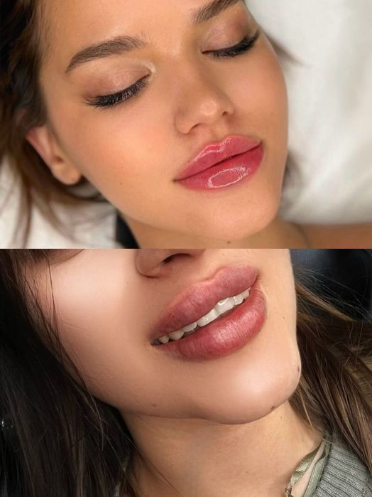 Збільшення губ ,Ботокс,Full Face,ліполітики