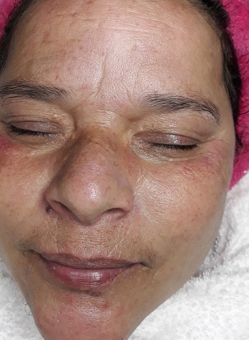 Limpeza De Pele