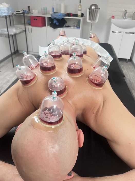 Хиджама . Гирудотерапия . Профилактика всех заболеваний. Обучение