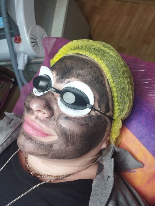 Карбоновий пілінг