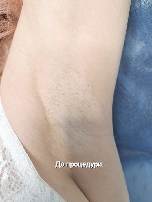 Електроепіляція, центр міста