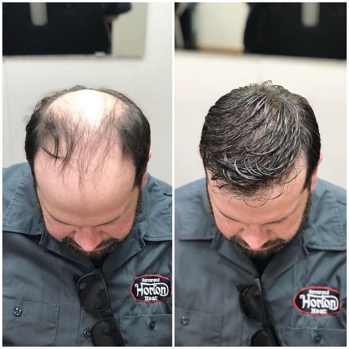 Curso Profissional de prótese capilar injetada em Alverca