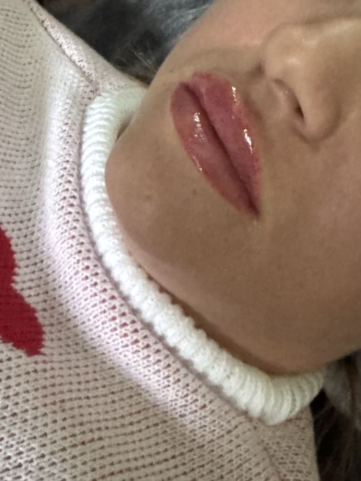 Чистка обличчя, обьєм губ, ботокс, пілінг, косметолог з ліцензією