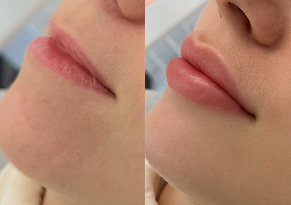 Контурна пластика губ