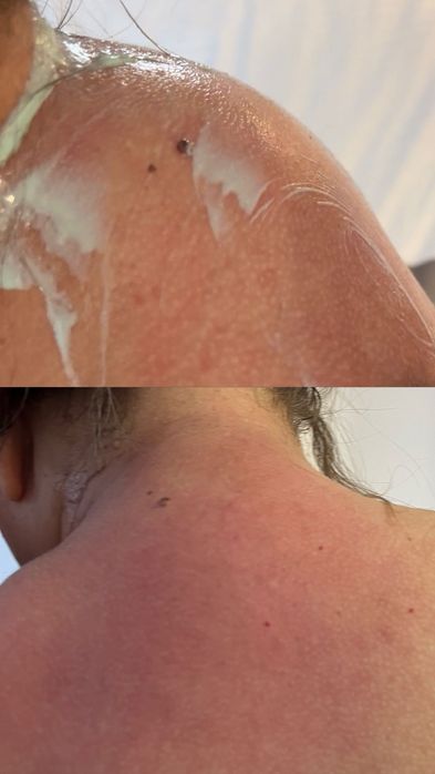 Лікування холки , корекція фігури