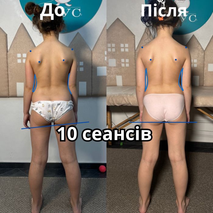 Дитячий масаж. Масаж при сколіозі. Лфк