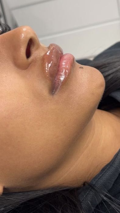 Увеличение губ Ботокс Уколы уколы красоты