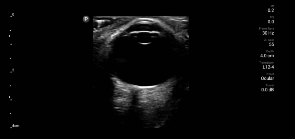 УЗД портативний Philips lumify L12-4