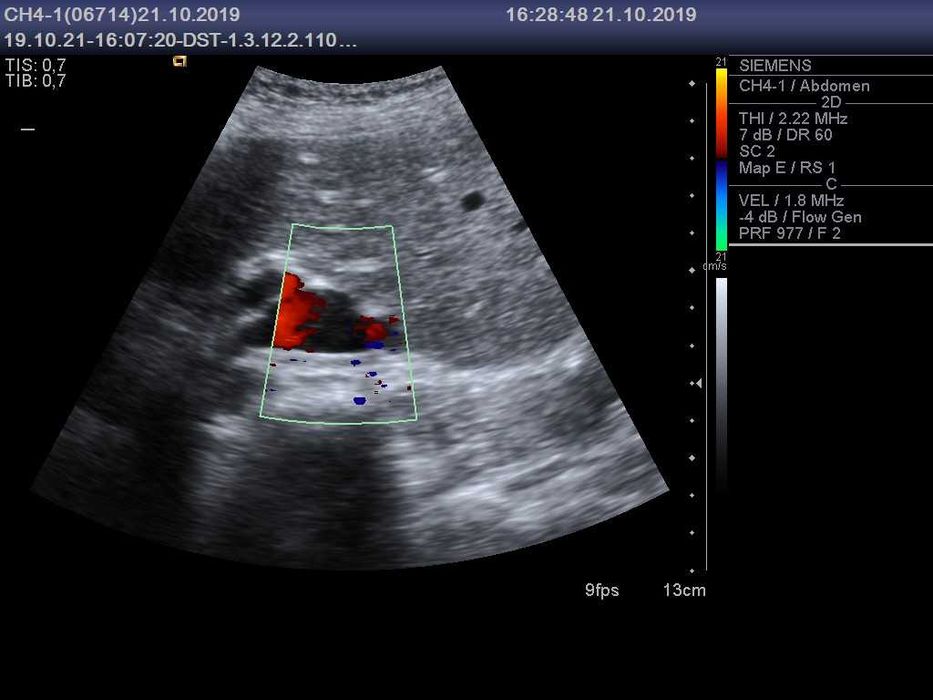 Конвексний датчик УЗД Siemens (Acuson) CH4-1