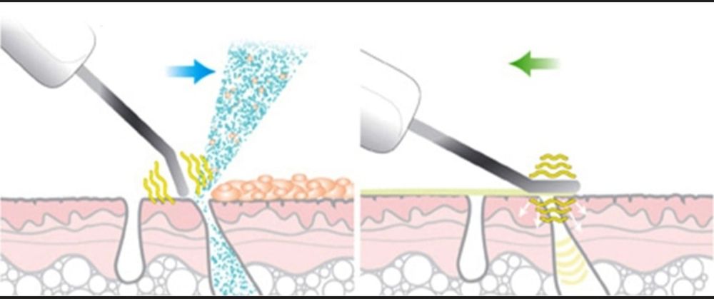 Ультразвуковой скрабер DOCTOR-101 для чистки и подтяжки лица