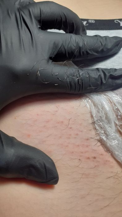 Електроепіляція та воскова депіляція. 10 років досвіду. Центр Бучі.