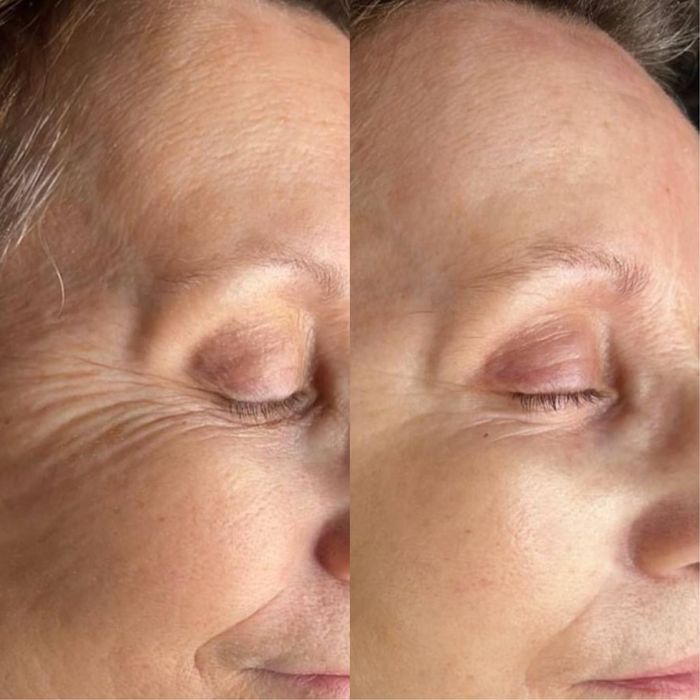 Ботулінотерапія по собівартості, модель ботокс від 500 грн АКЦІЯ