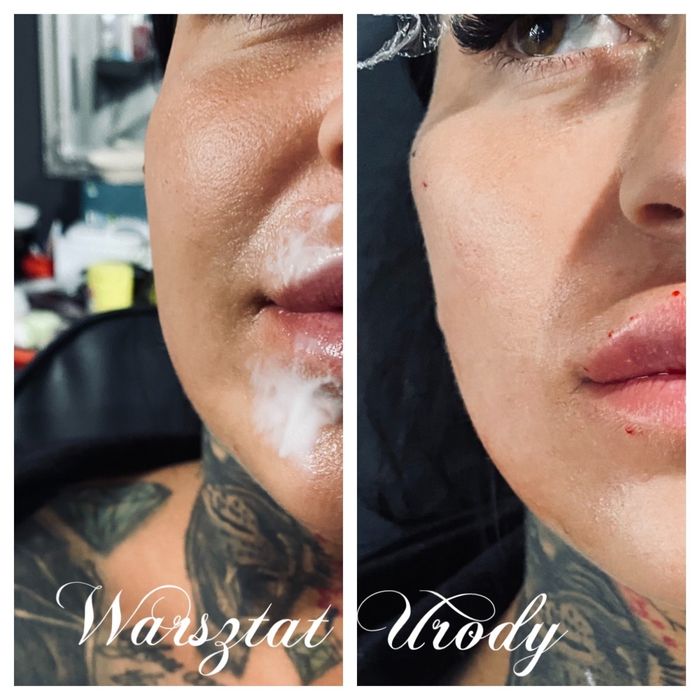 300zł= Kwas Hialuronowy Powiększenie Ust / Wolumetria 250z/ BOTOKS 200