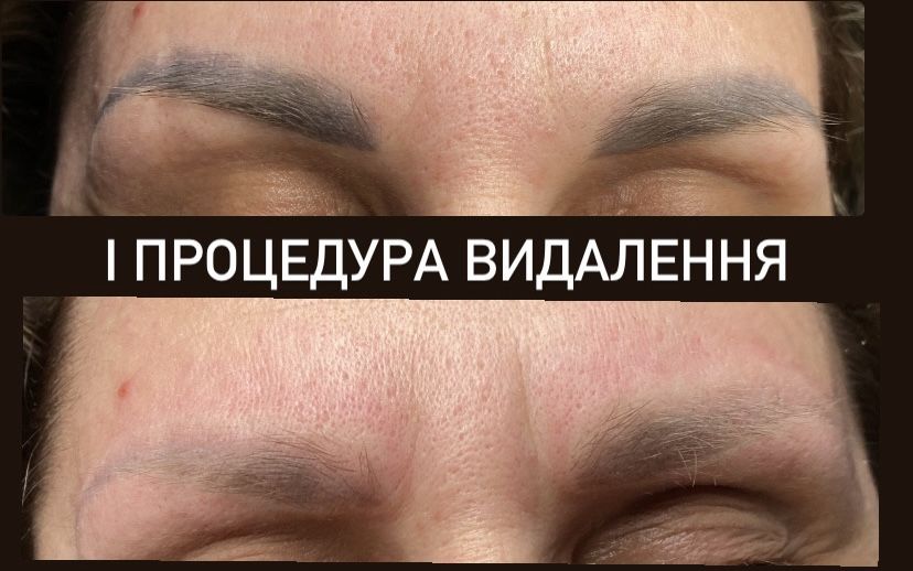 Видалення татуажа тату перманента лазером бровей стрелок губ ремувер