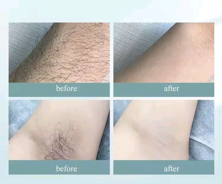 Лазерний епілятор