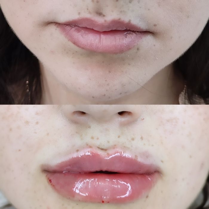 1500 грн губи контурна пластика.Ботокс.