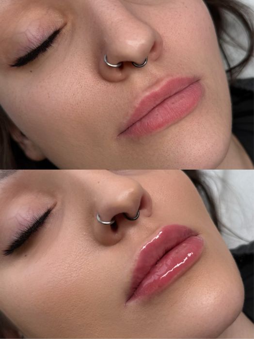 Modelowanie ust kwasem hialuronowym / stymulatorem