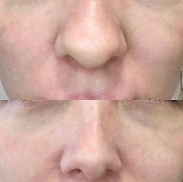 Косметолог моделі на(губи,ботокс,смас,рф голка,схуднення,худе обличчя)