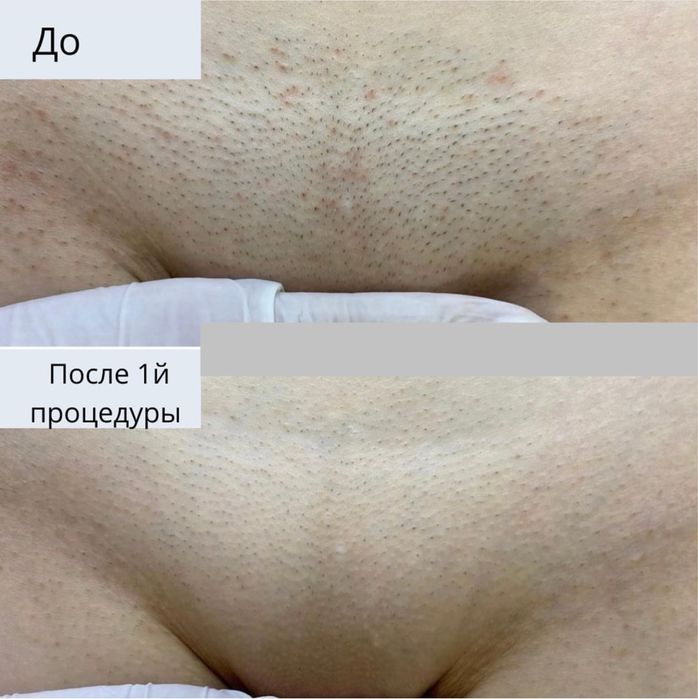 Лазерная эпиляция