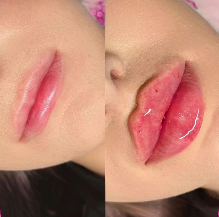 2000грнг губи Акція!Збільшення губ,контурна пластика губ,аугментація г