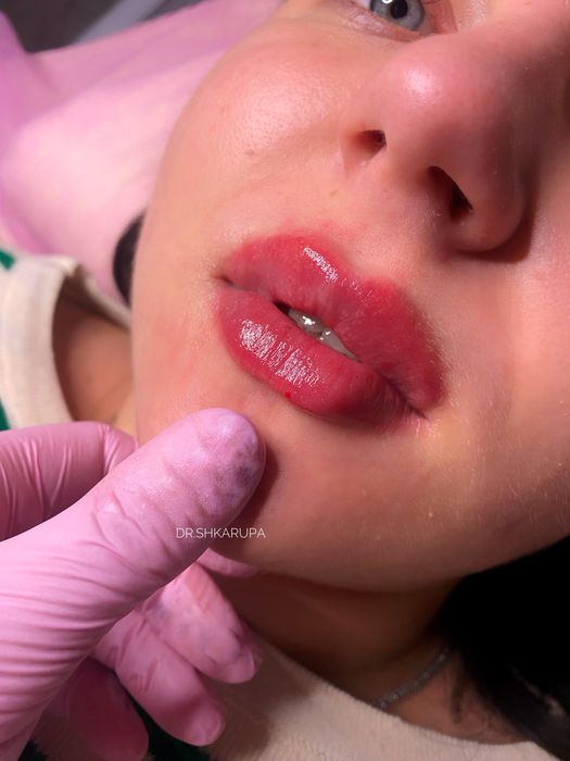 Акція! Stylage M / Контурна пластика губ /увеличение губ