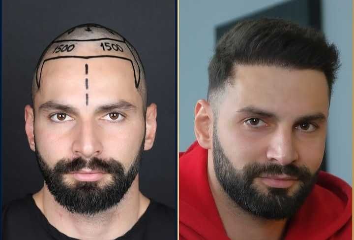 Transplante Capilar/Barba Istambul(Turquia) 2950€ TUDO INCLUIDO