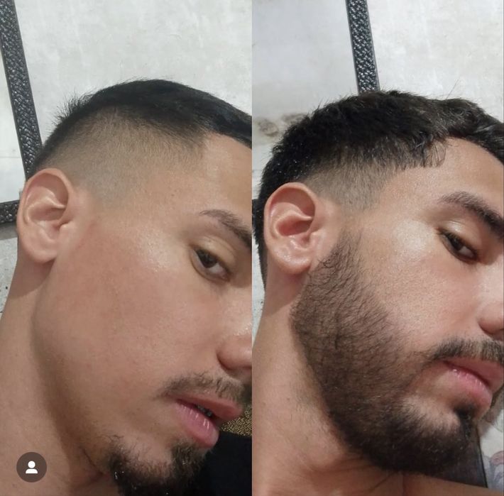 Minoxidil kirkland e Foligain extra forte