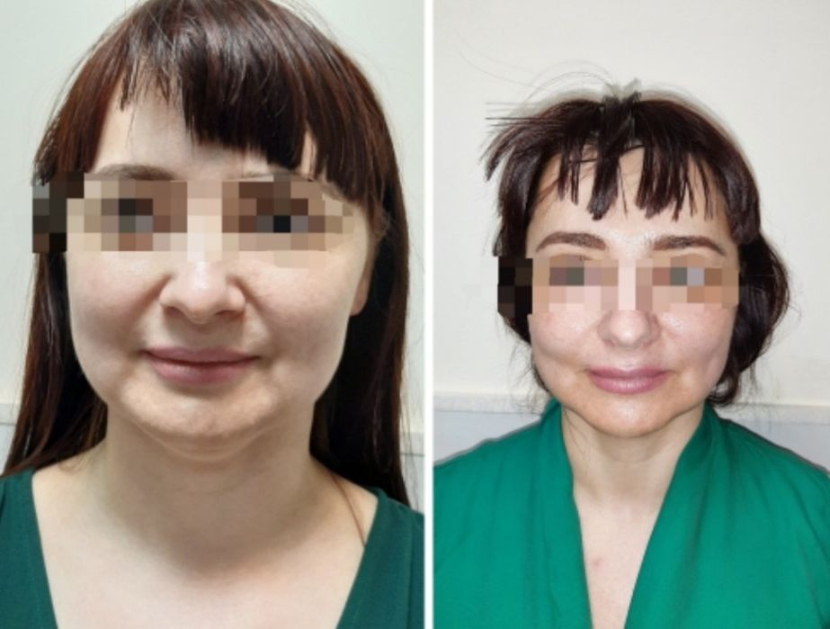 Міофасціальний,  моделюючий, лімфодренажний масаж обличчя + маска