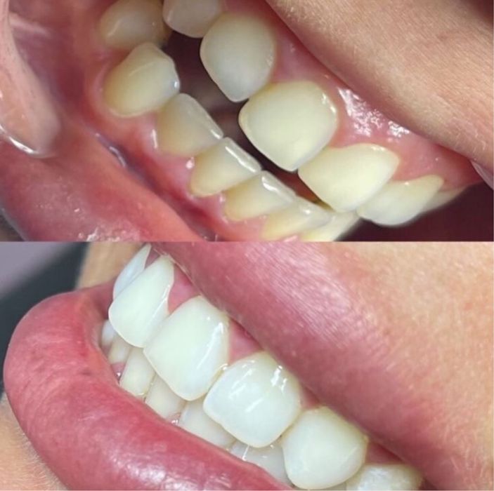 Косметичне відбілювання зубів, ламінування та лед-нарощування вій