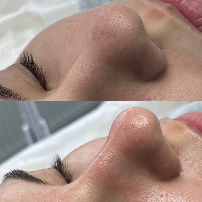 Послуги косметолога Львів чистка обличя біоревіталізація ботокс