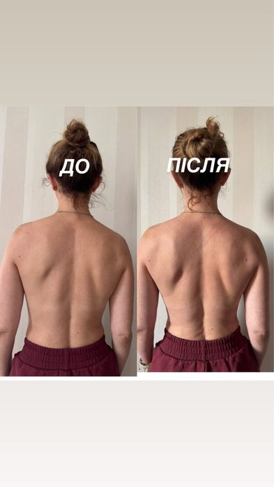 Вирівнювання спини | Реабілітація.