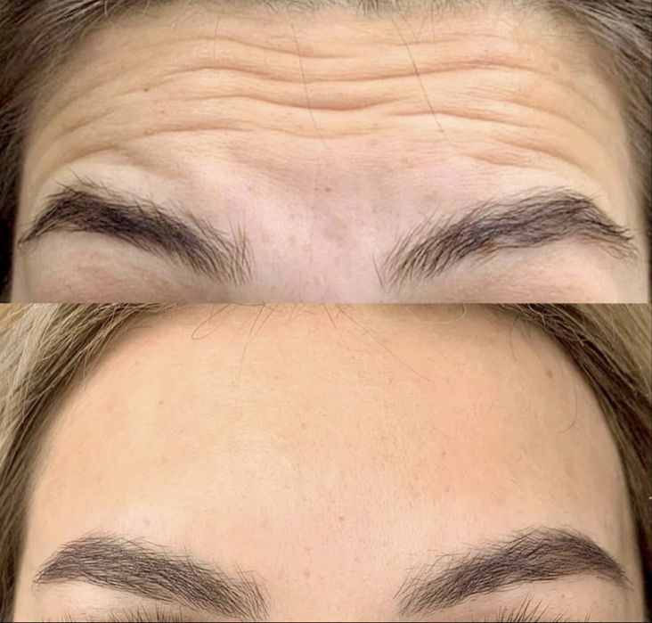 Ботокс! Ботулінотерапія