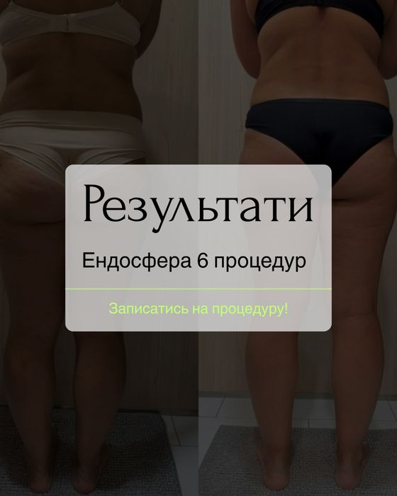 Ендосфера Львів / пресотерапія /кавітація/ rf lifting Львів