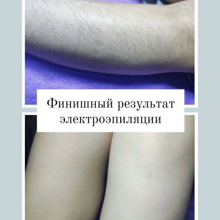 Электроэпиляция, Одесса,Таирова (Альтаир) Черемушки