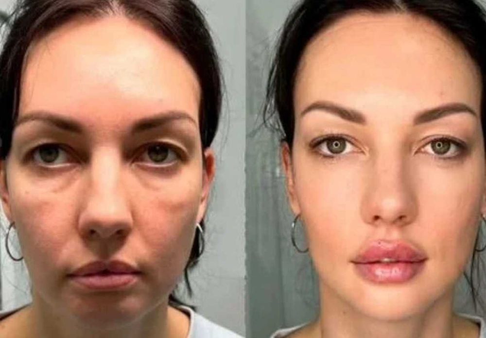 Usta/botox/mezoterapia