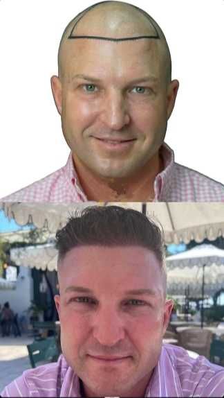 Transplante Capilar/Barba Istambul(Turquia) 2950€ TUDO INCLUIDO