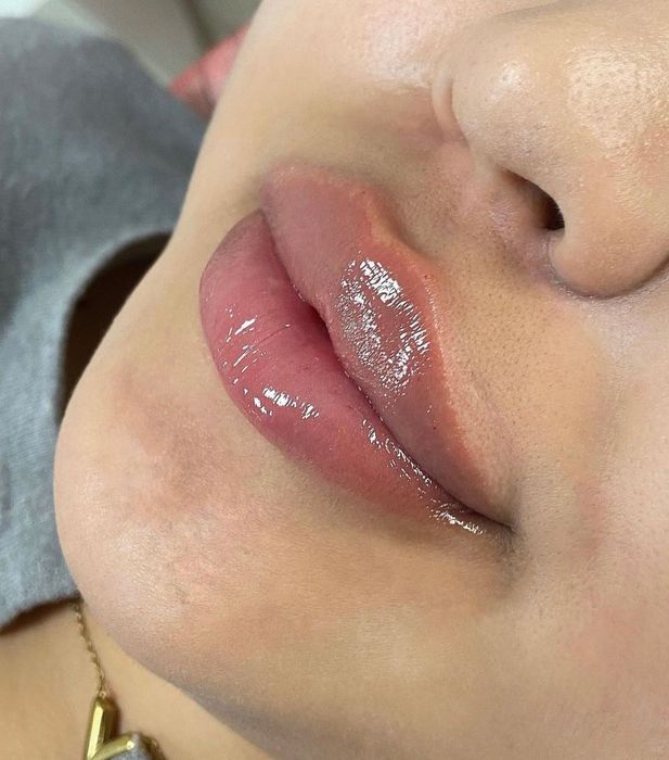 Збільшення губ ,Ботокс,Full Face,ліполітики