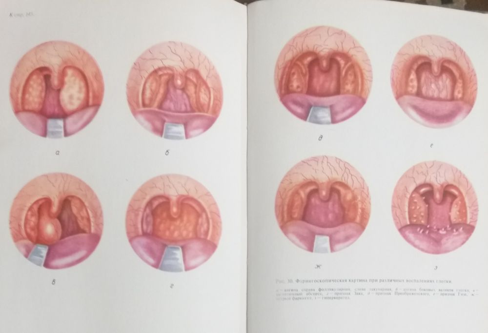 Болезни  уха горла носа