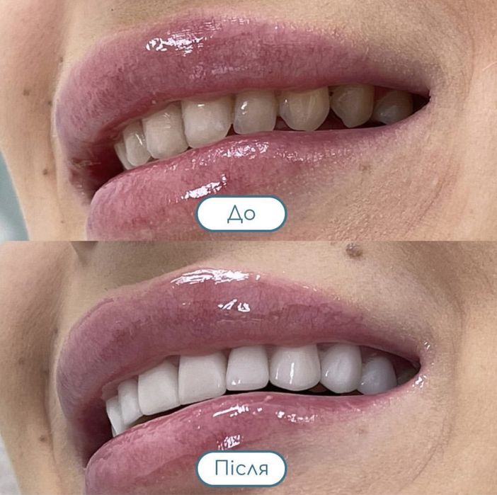 Керамічні вініри. Київ, 13500 грн . Акція! ВСЕ ВКЛЮЧЕНО!!! Е.max